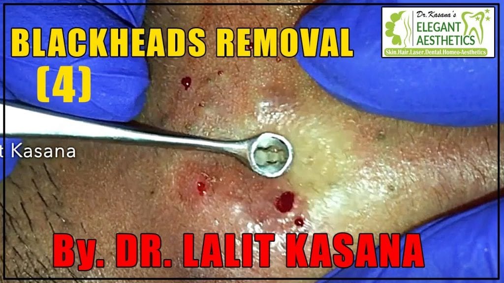Thick Blackheads Removal 1