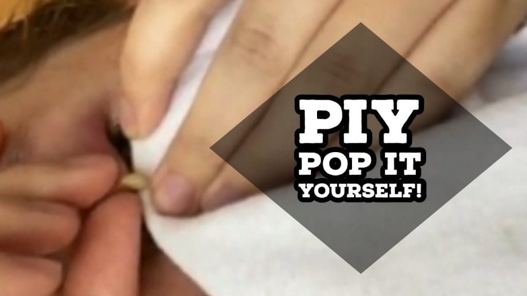 Amateur Zit Pops 2 Amateur Zit Pops 1