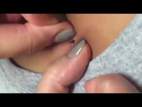 Blackhead pushed out 1
