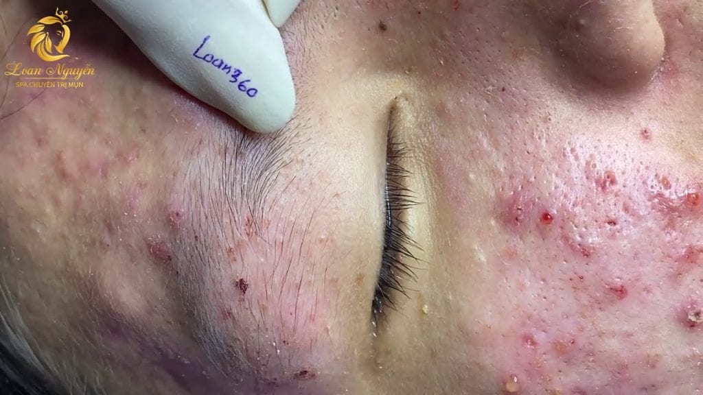 Cystic Acne 2 Cystic Acne 1