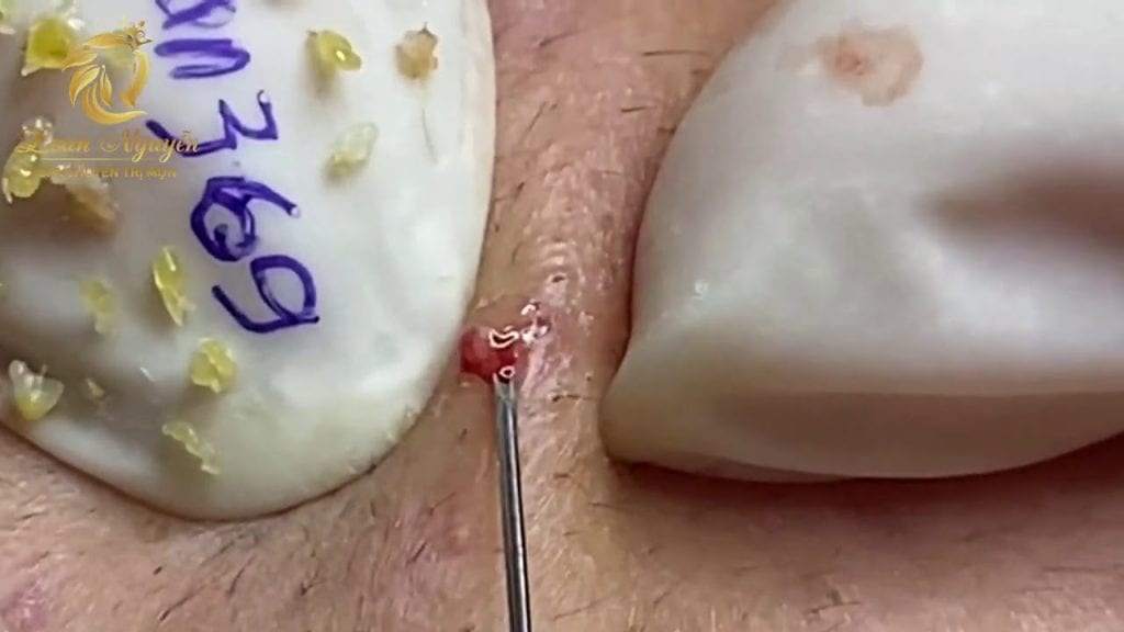 Magic pimple extractions 1