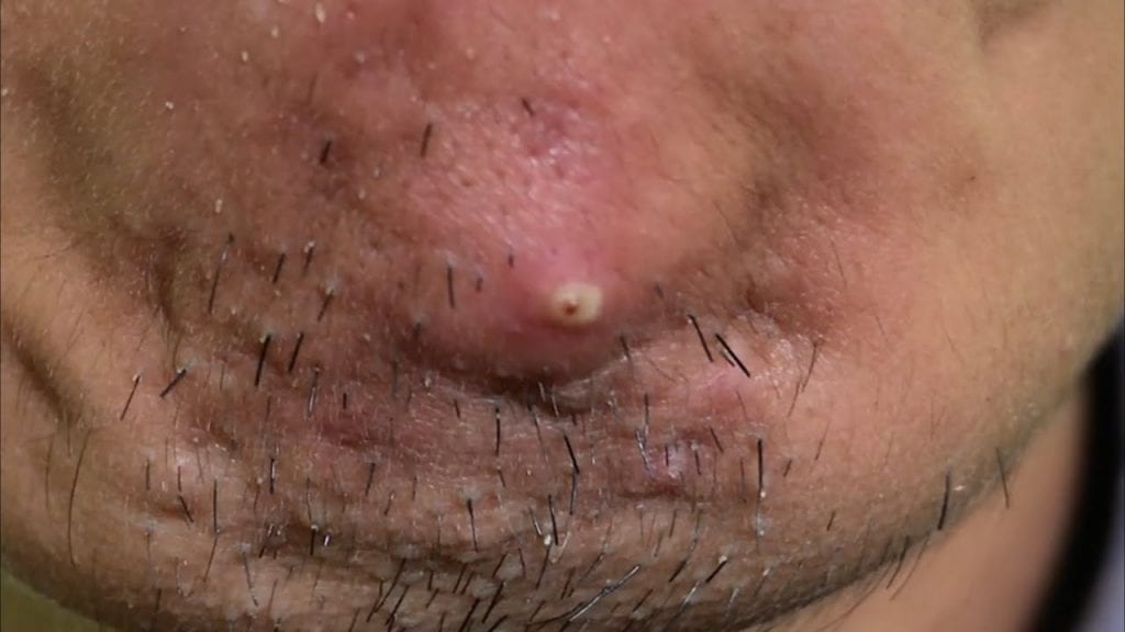 Old fashioned pimple popping 1