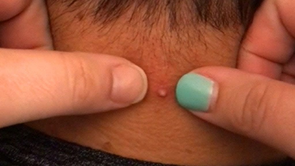 Pimple Popping Video 2 Pimple Popping Video 1