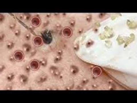 Pimple Stress Relief 1
