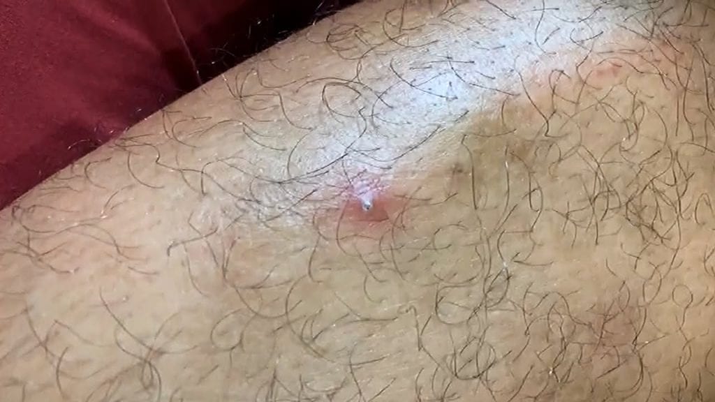 Amateur Pimple Popping 2 Amateur Pimple Popping 1