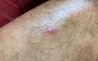 Amateur Pimple Popping 2 Amateur Pimple Popping 2