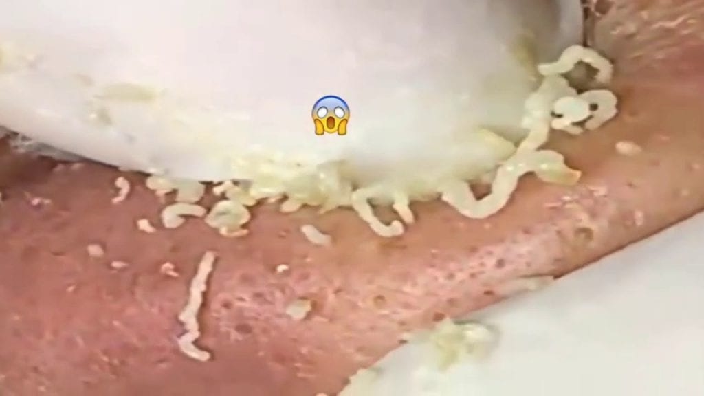 Bad Skin with Pus 1