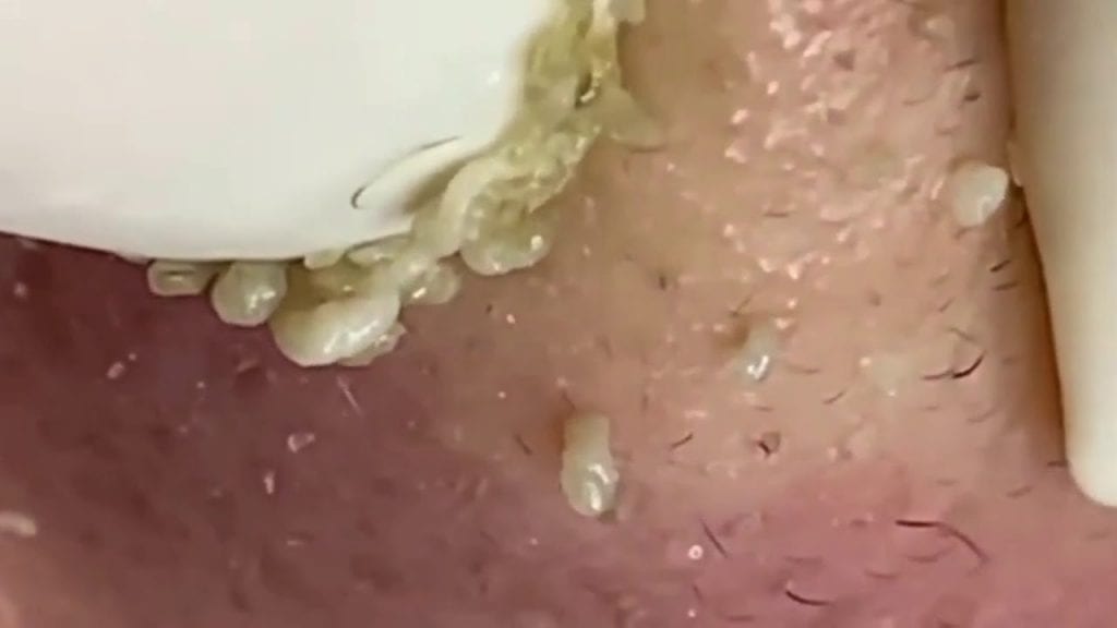 Close up pimple squeezes 1