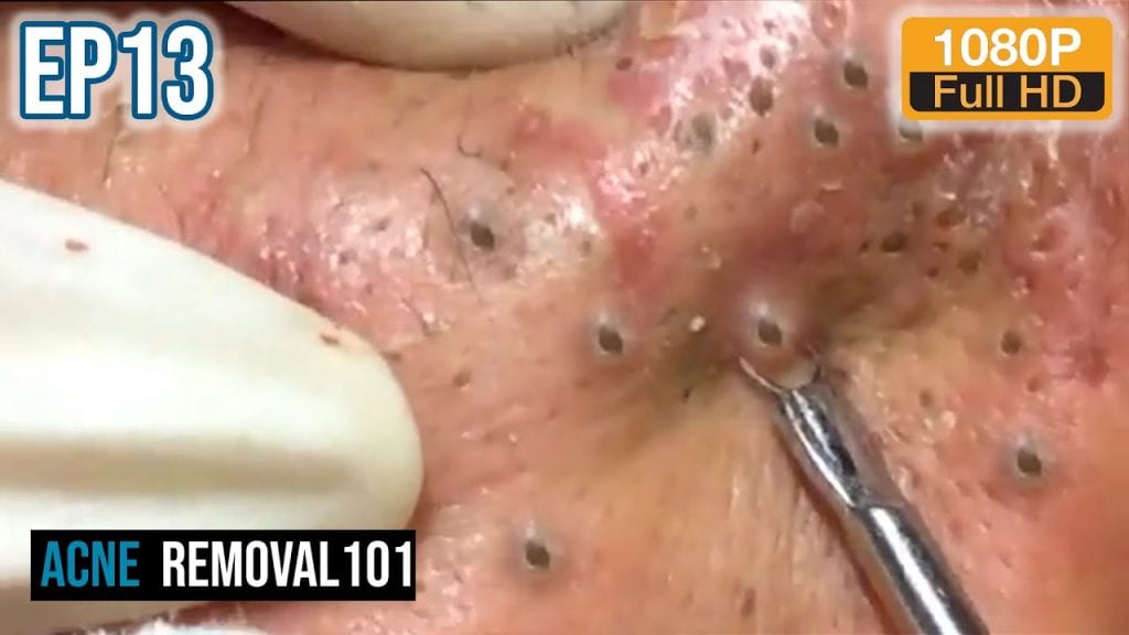 Cystic Acne Extractions 2 Cystic Acne Extractions 1