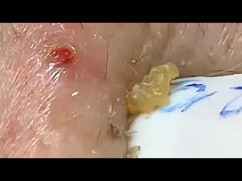 Digging for Whiteheads 1