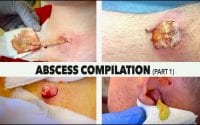 Dr Paul Abscess Compilation 2 Dr Paul Abscess Compilation 2