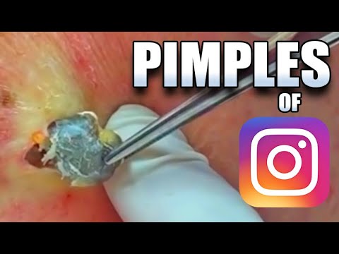 Instagram Pimple Compilation 1