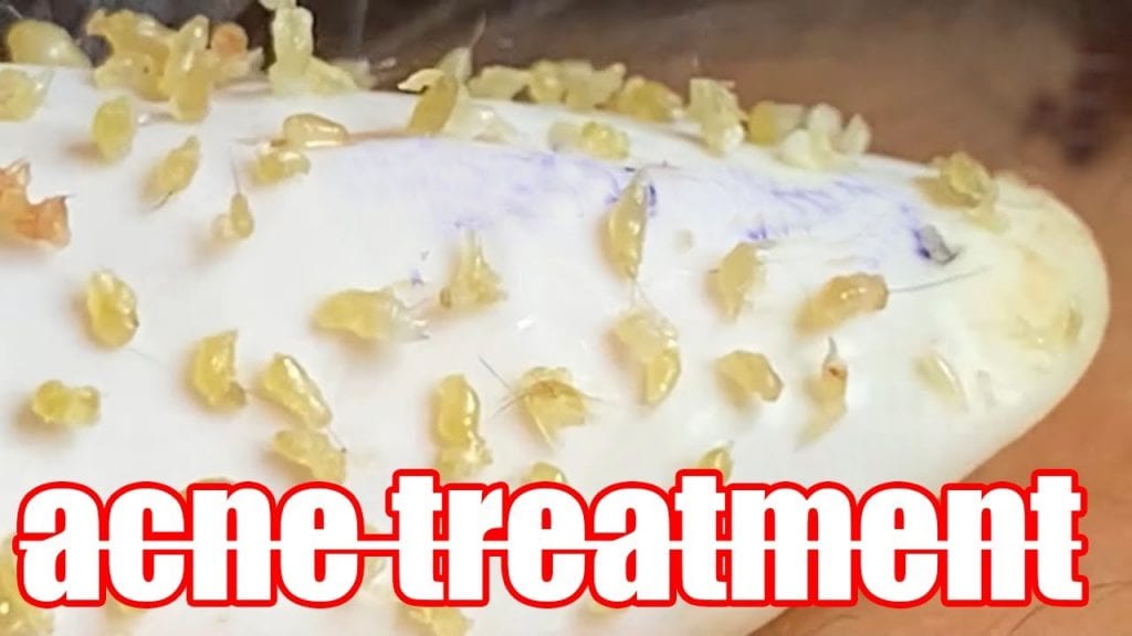 Lily Spa Acne Extractions 1