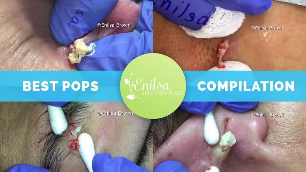 Pimple Compilation 2 Pimple Compilation 1