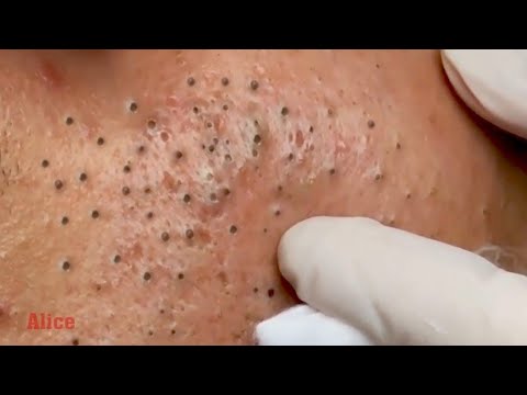 Pimple Pop Opinions? 1
