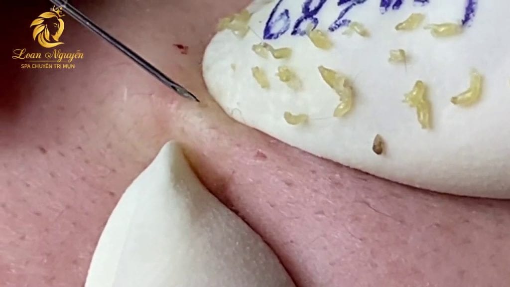 Pimple Popping and Blackheads 1