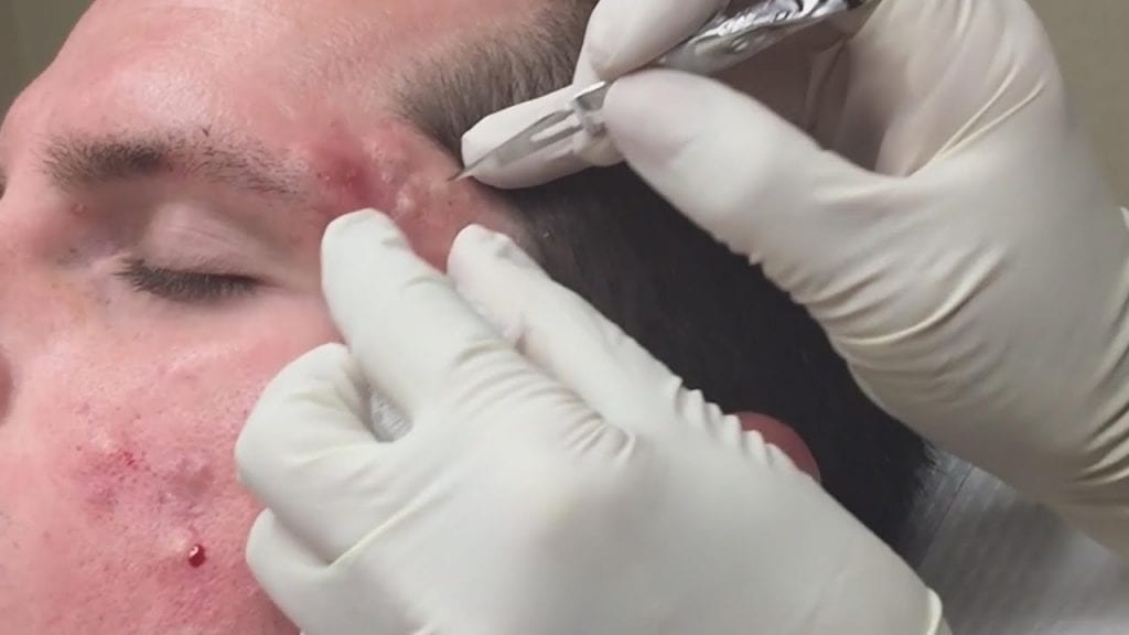 This is Zit 2 This is Zit 1