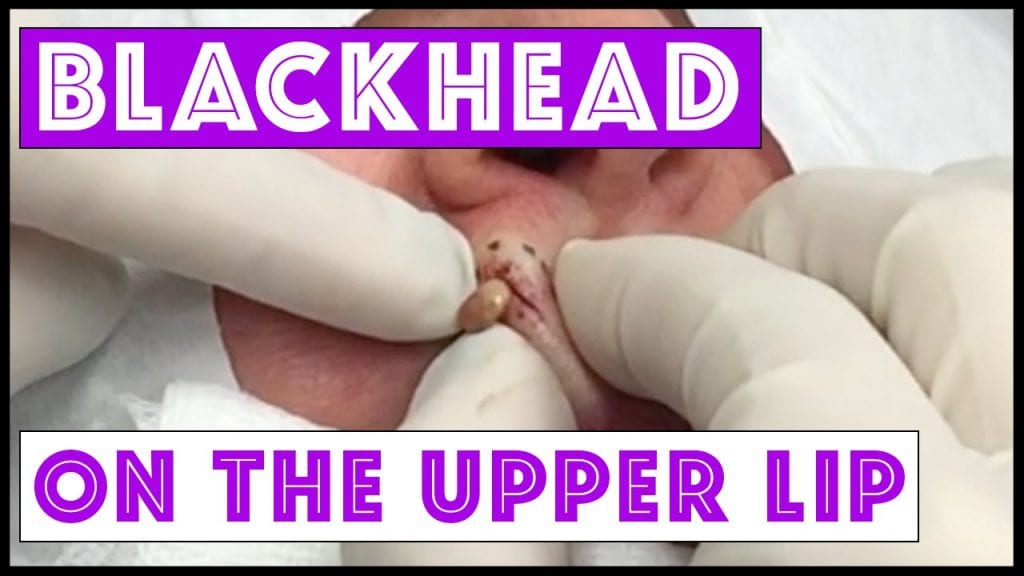 Blackhead on lip 1