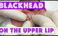 Blackhead on lip 1 Blackhead on lip 1