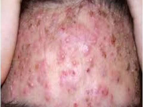 Blackheads - lots of em 2 Blackheads - lots of em 1