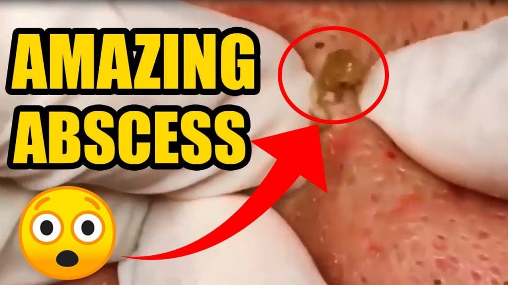 Cute little blackheads and sebaceous cysts 1