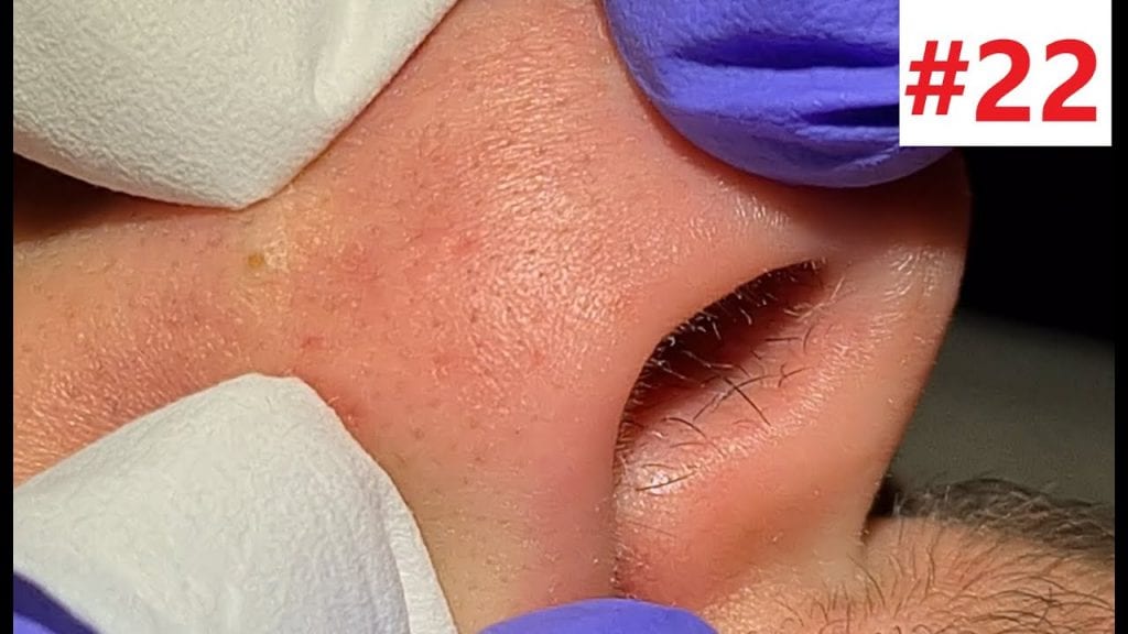 Happy Blackheads 1