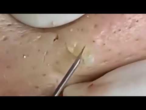 Ingrown hair extraction 1