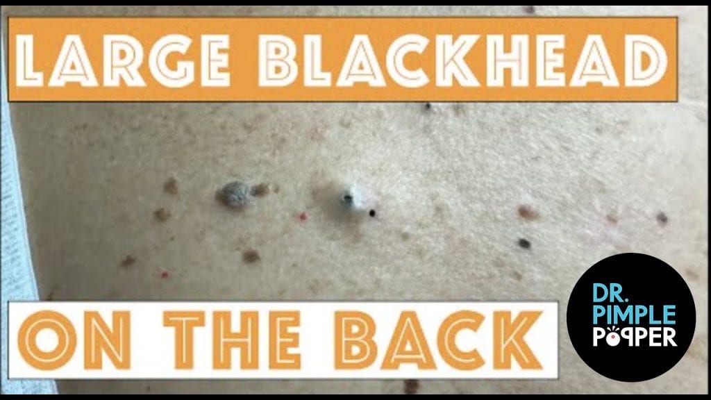 Large Back Blackheads 1