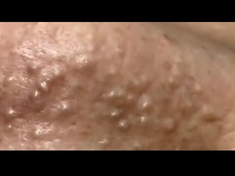 Milia Extractions 1