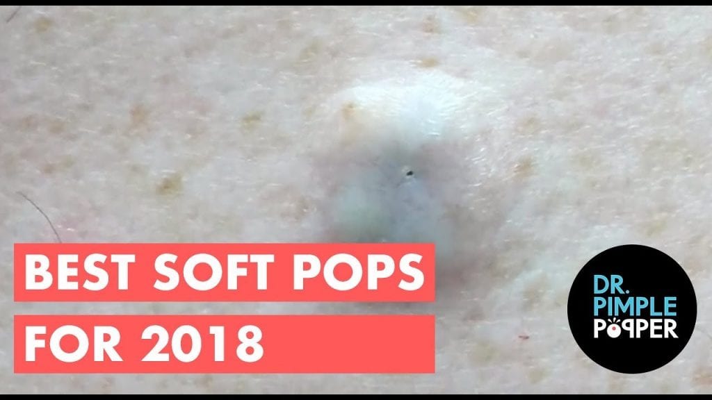 Soft Pimple Pops 2 Soft Pimple Pops 1