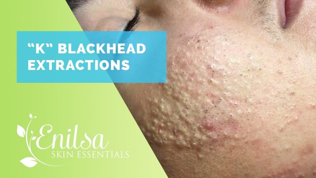 Whiteheads and Blackheads on K 2 Whiteheads and Blackheads on K 1