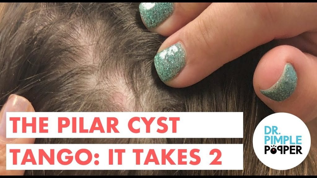 Pilar Cyst 1
