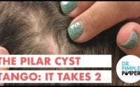 Pilar Cyst 3