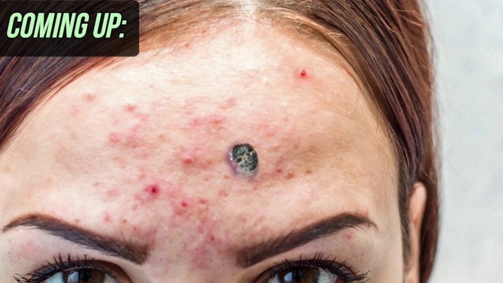 Pimple Compilation 1