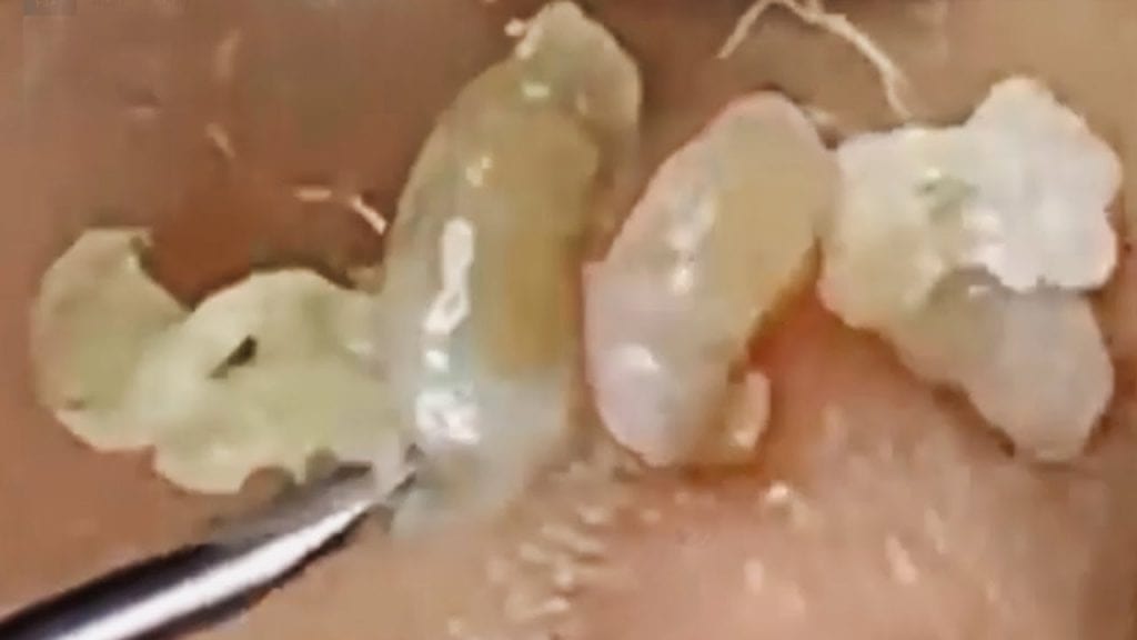 Pimple popping - little baby bumps 1