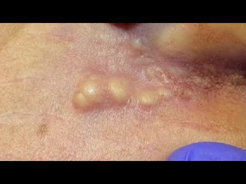 Whiteheads and Blackheads on Ear 2 Whiteheads and Blackheads on Ear 1