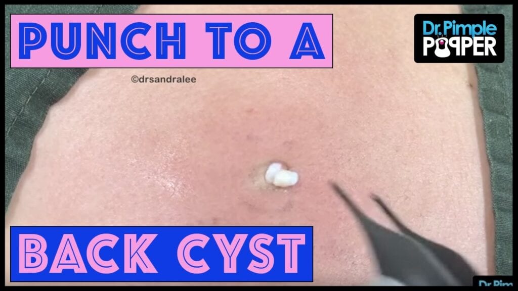 Annoying Epidermoid Cyst 1