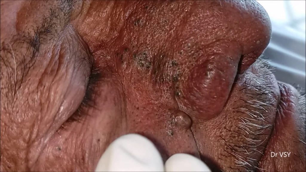 Blackhead Battle 1