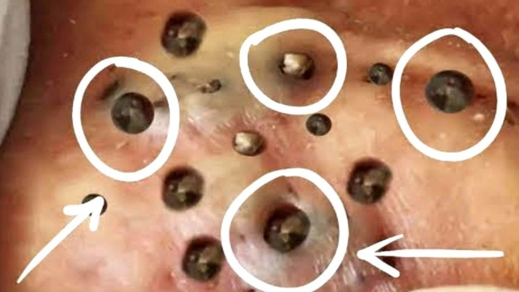 Blackhead Extractions 1