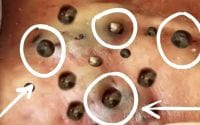 Blackhead Extractions 3 Blackhead Extractions 3