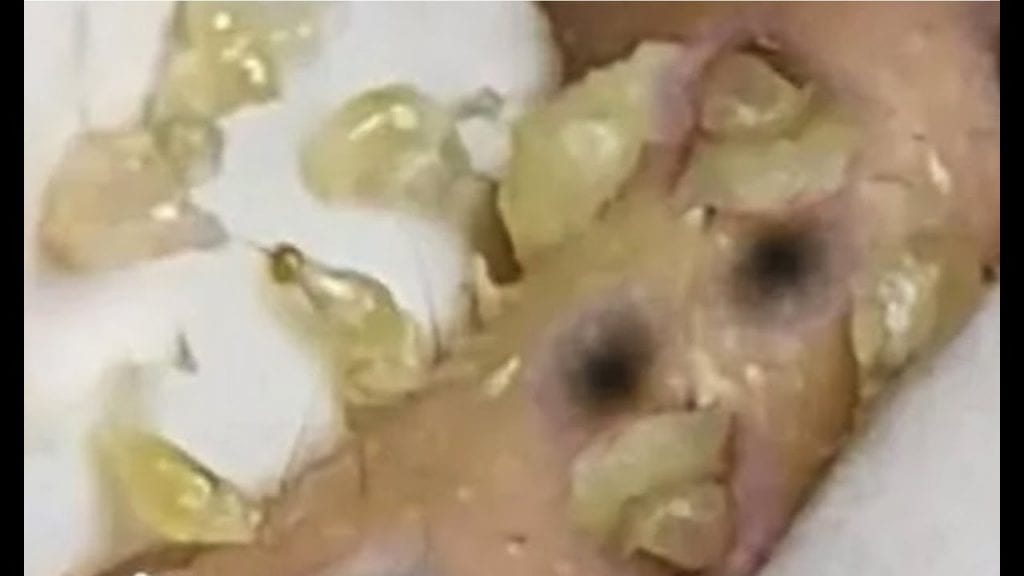 Close up Pimple Extractions 2 Close up Pimple Extractions 1