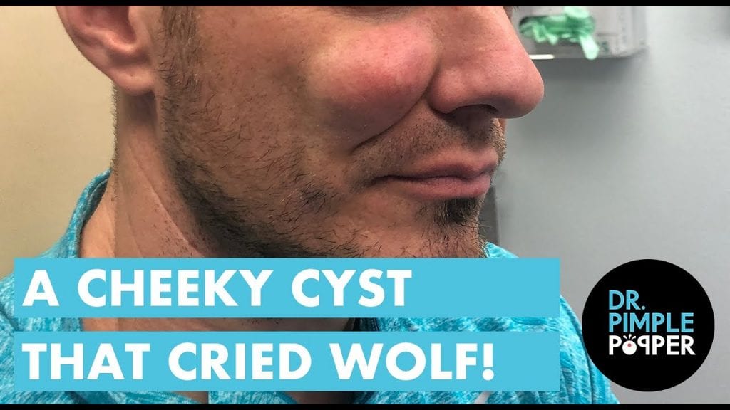 Giant Cheek Cyst 2 Giant Cheek Cyst 1