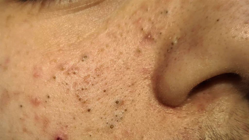 Josefa Pops Blackheads 2 Josefa Pops Blackheads 1