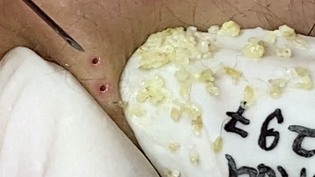 Loan Nguyen Pimple Pops 1