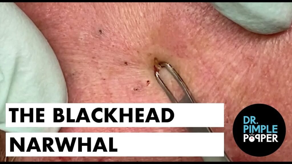 Classic Dr Pimple Popper 1