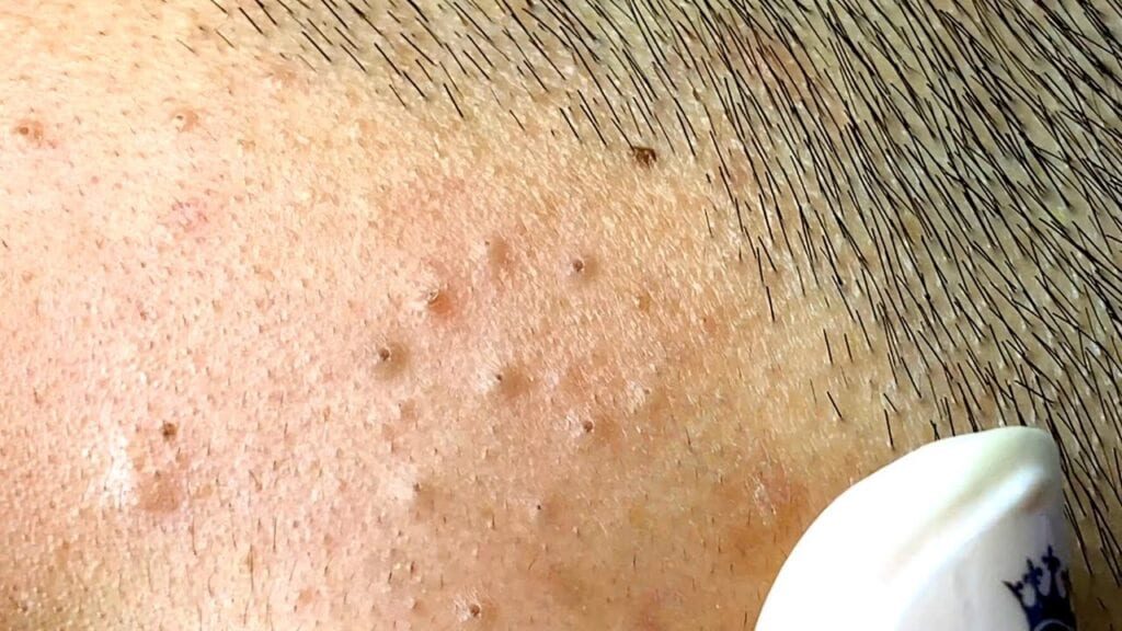 Bad-a** Zit Popping 1