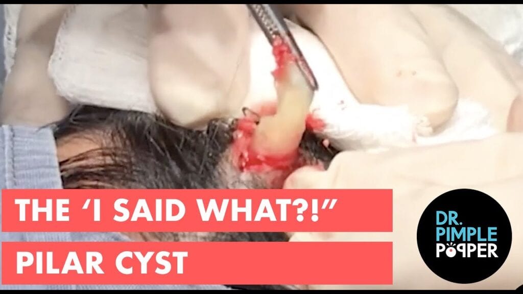 Dr Pimple Popper - Pilar Cyst 1