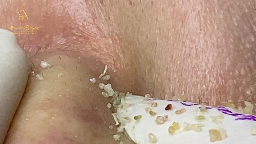 Loan’s Poppin Pimples 2 Loan’s Poppin Pimples 1