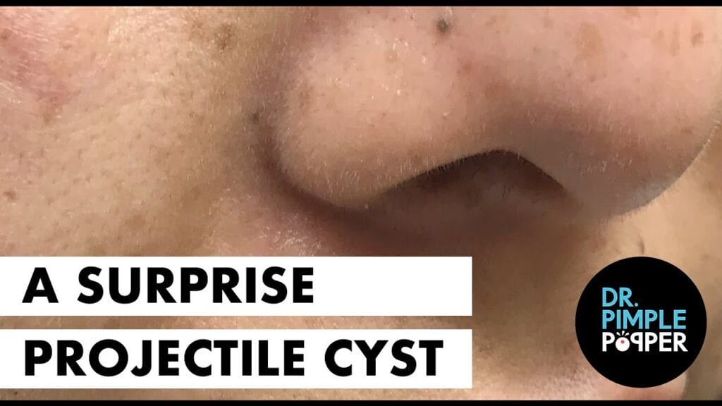 Pilar Cyst 1