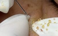Pimple Pro Loan 1 Pimple Pro Loan 1